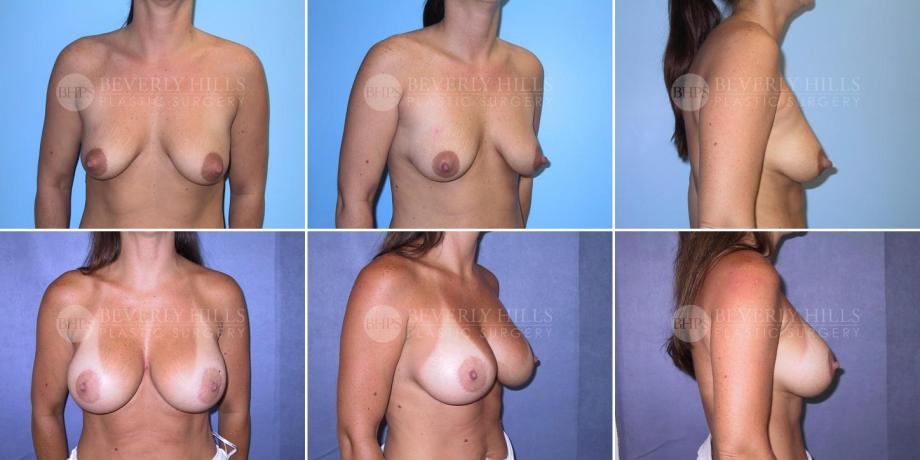 Beverly Hills Plastic Surgery gallery image 264
