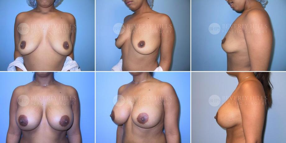 Beverly Hills Plastic Surgery gallery image 265
