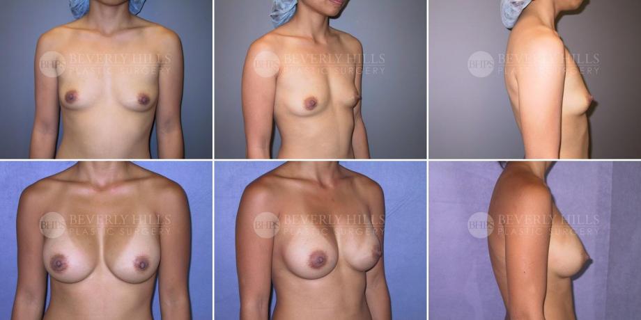 Beverly Hills Plastic Surgery gallery image 266