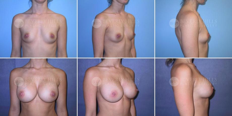 Beverly Hills Plastic Surgery gallery image 267