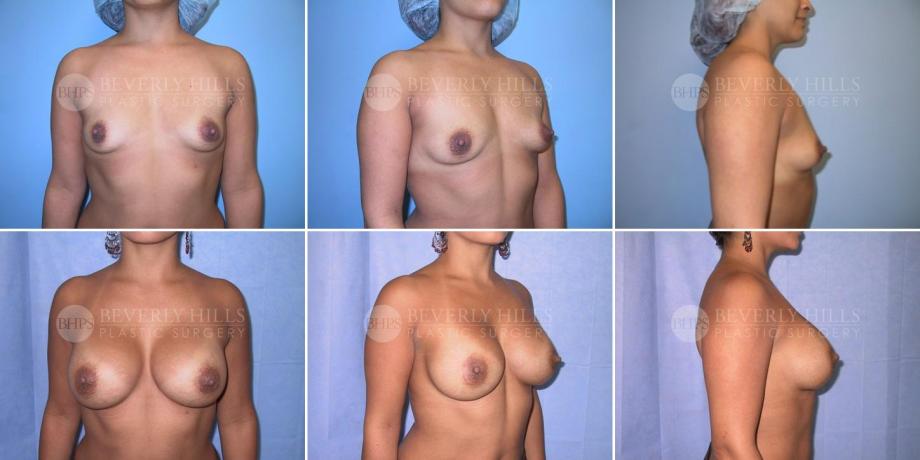 Beverly Hills Plastic Surgery gallery image 268