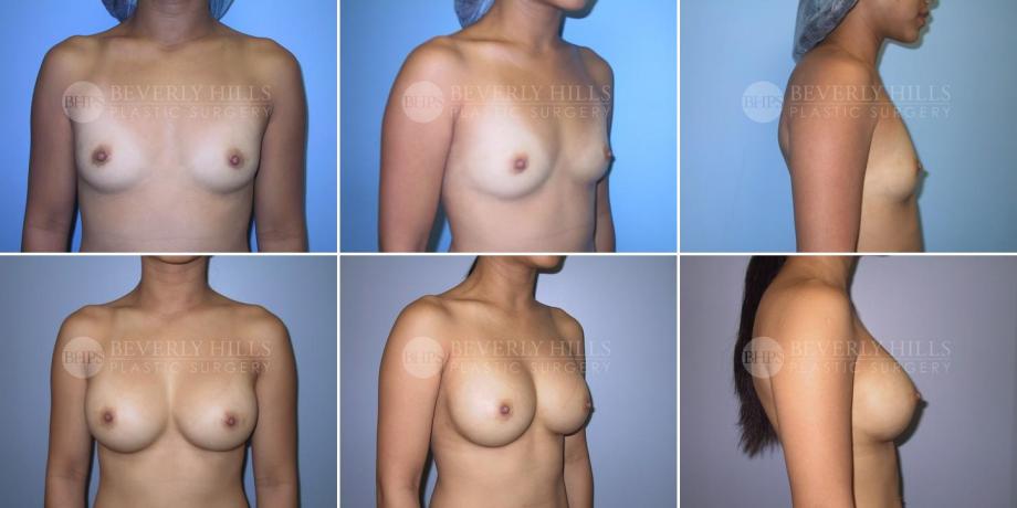 Beverly Hills Plastic Surgery gallery image 269