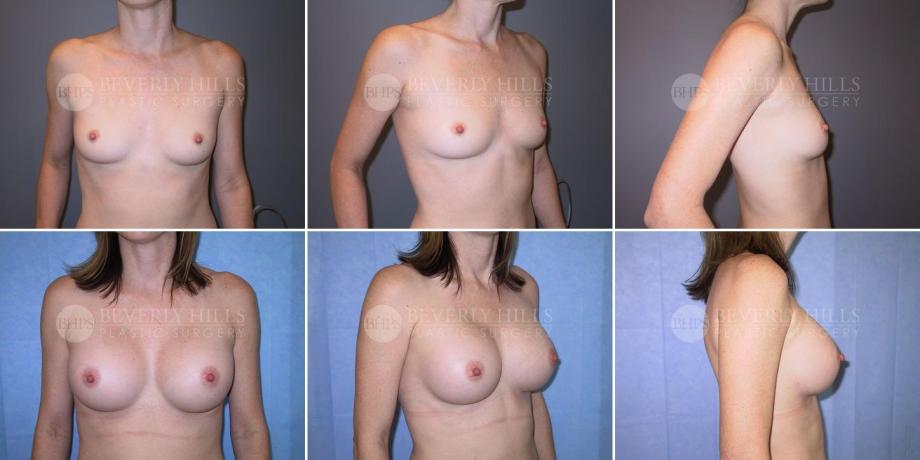 Beverly Hills Plastic Surgery gallery image 272
