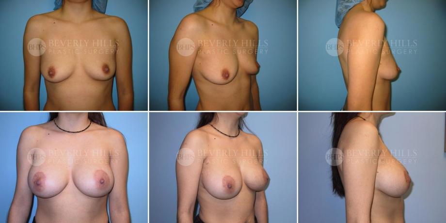 Beverly Hills Plastic Surgery gallery image 274