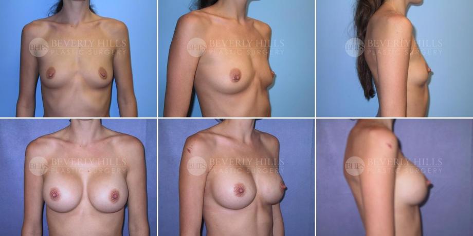 Beverly Hills Plastic Surgery gallery image 278