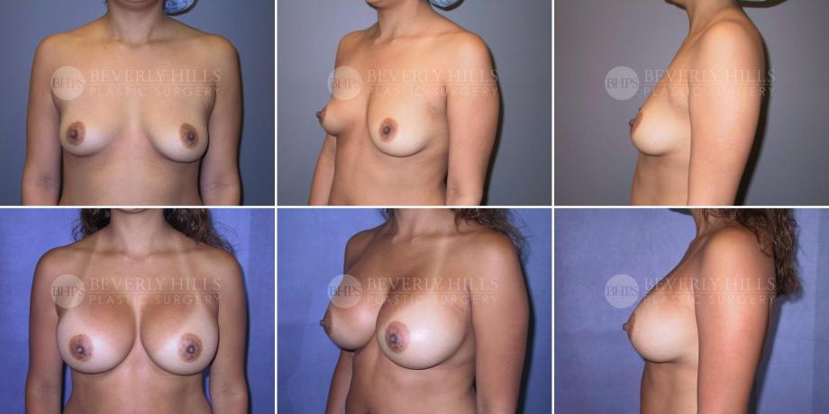 Beverly Hills Plastic Surgery gallery image 282