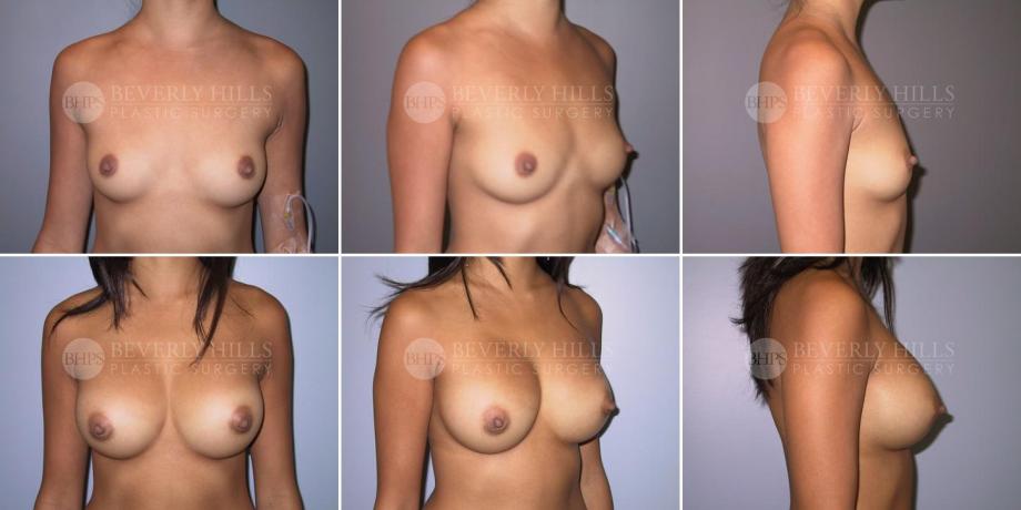 Beverly Hills Plastic Surgery gallery image 284