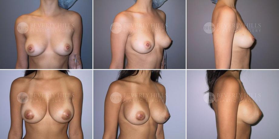Beverly Hills Plastic Surgery gallery image 285