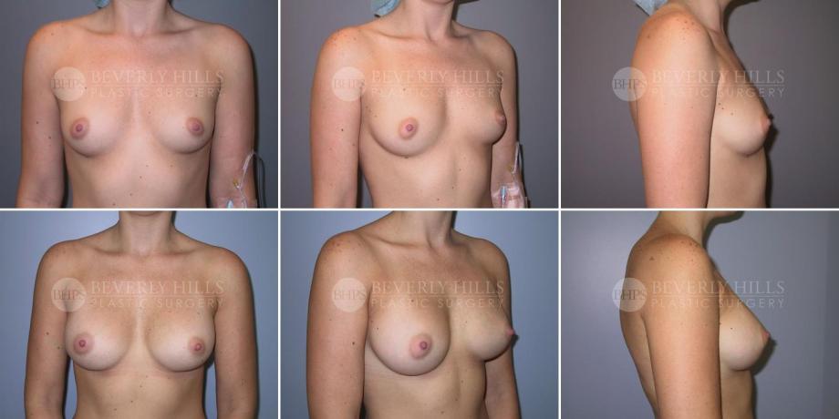 Beverly Hills Plastic Surgery gallery image 286