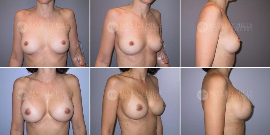 Beverly Hills Plastic Surgery gallery image 287