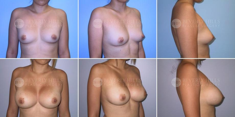 Beverly Hills Plastic Surgery gallery image 288