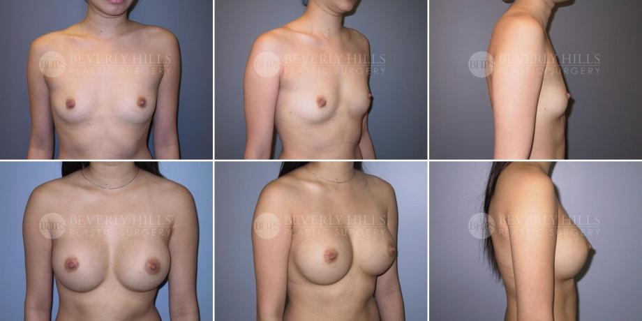 Beverly Hills Plastic Surgery gallery image 289
