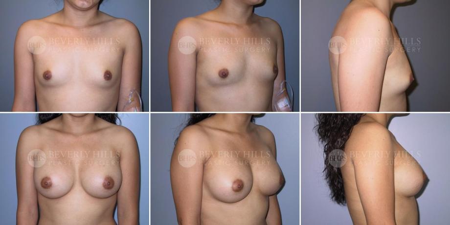 Beverly Hills Plastic Surgery gallery image 292
