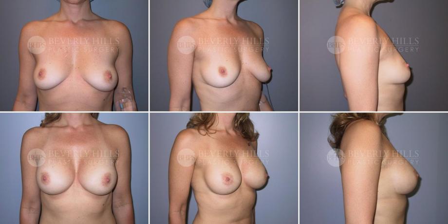 Beverly Hills Plastic Surgery gallery image 293