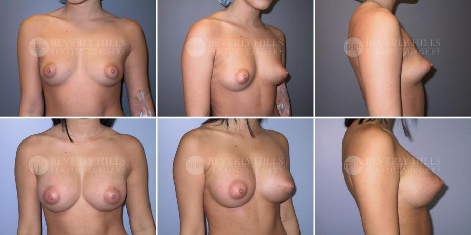 Beverly Hills Plastic Surgery gallery image 294