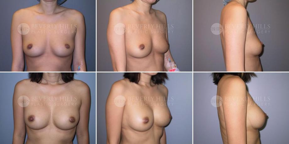 Beverly Hills Plastic Surgery gallery image 298