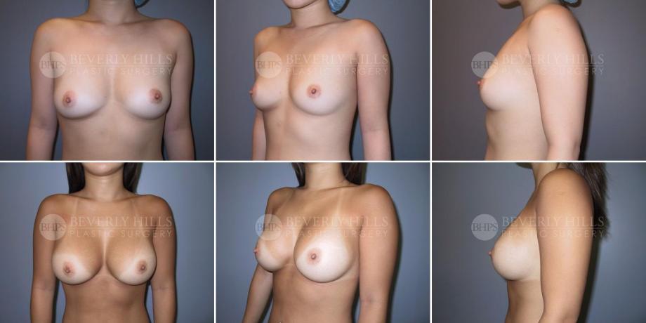 Beverly Hills Plastic Surgery gallery image 299