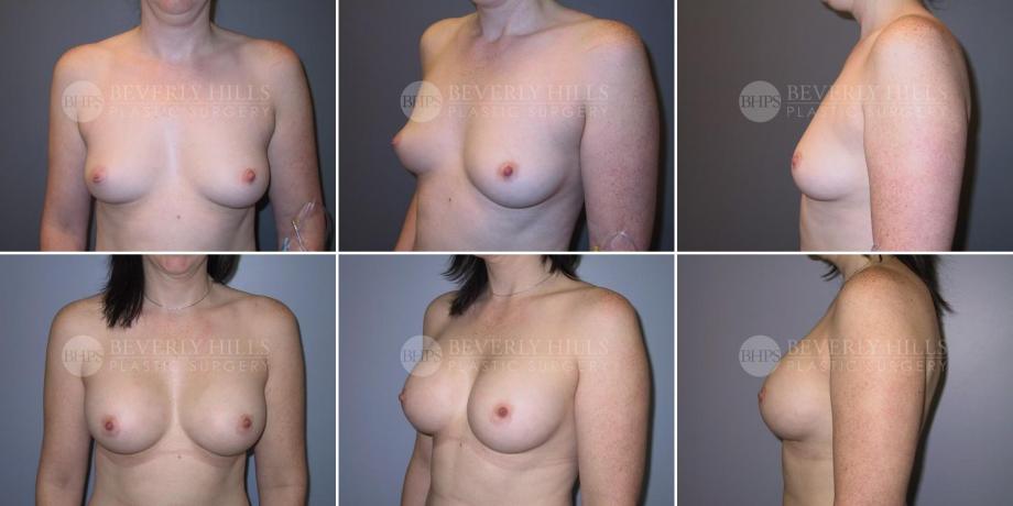 Beverly Hills Plastic Surgery gallery image 301