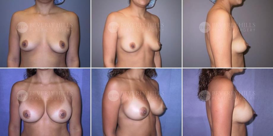 Beverly Hills Plastic Surgery gallery image 304
