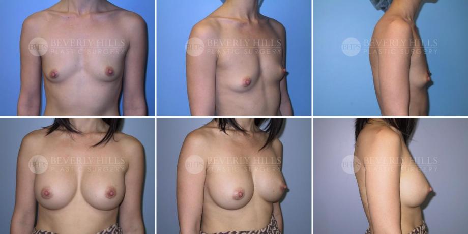 Beverly Hills Plastic Surgery gallery image 305