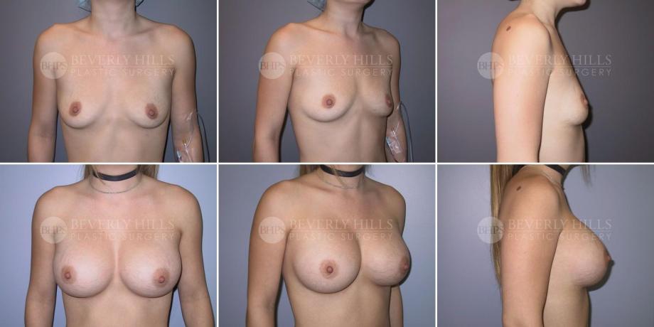 Beverly Hills Plastic Surgery gallery image 306