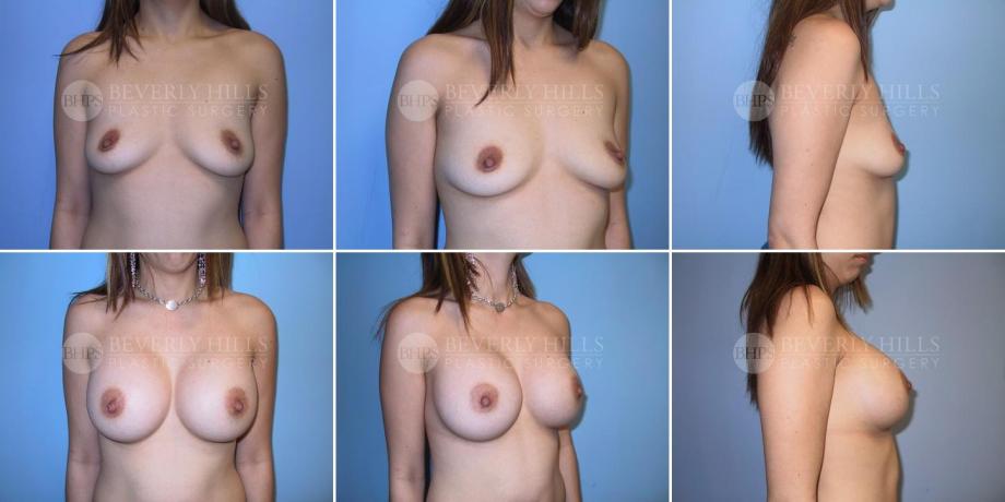 Beverly Hills Plastic Surgery gallery image 308