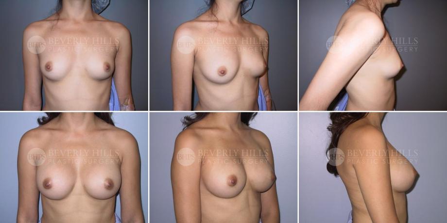 Beverly Hills Plastic Surgery gallery image 311