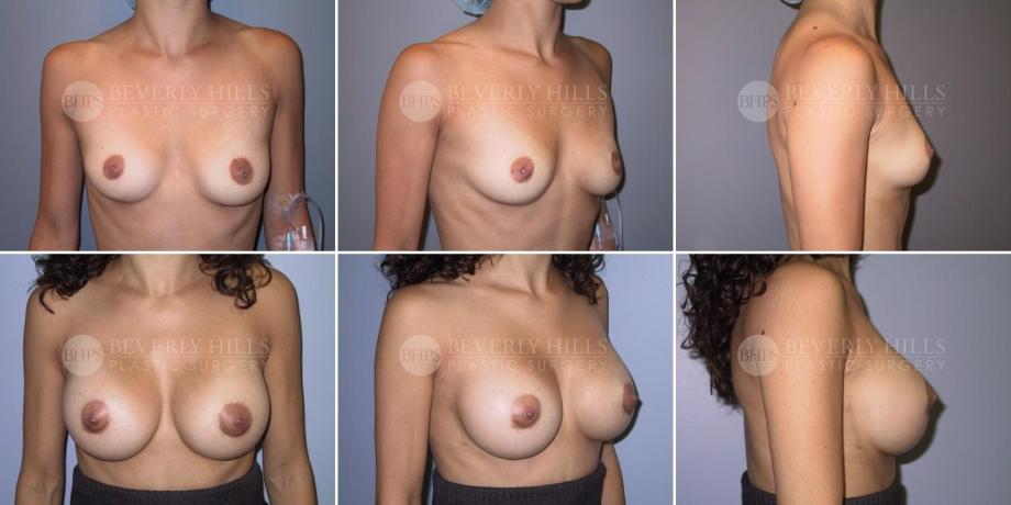Beverly Hills Plastic Surgery gallery image 317
