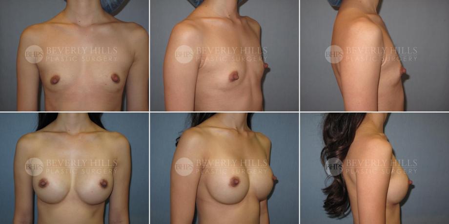 Beverly Hills Plastic Surgery gallery image 319