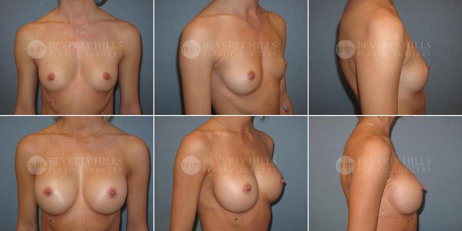 Beverly Hills Plastic Surgery gallery image 320