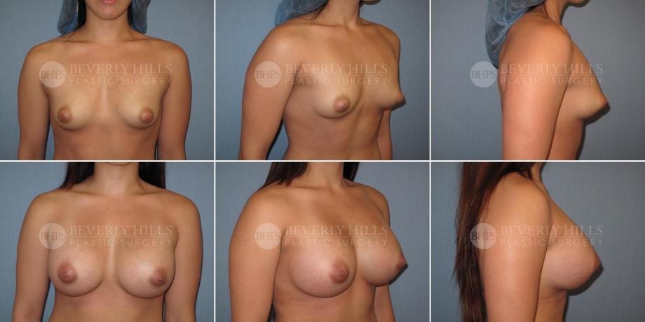 Beverly Hills Plastic Surgery gallery image 322