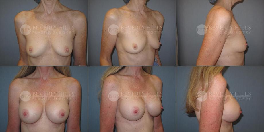 Beverly Hills Plastic Surgery gallery image 328