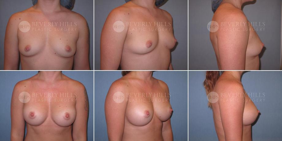 Beverly Hills Plastic Surgery gallery image 329