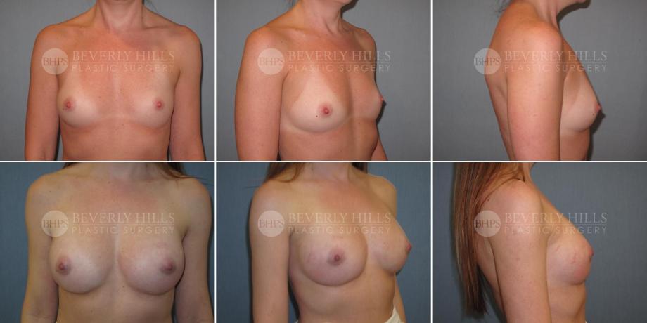 Beverly Hills Plastic Surgery gallery image 334