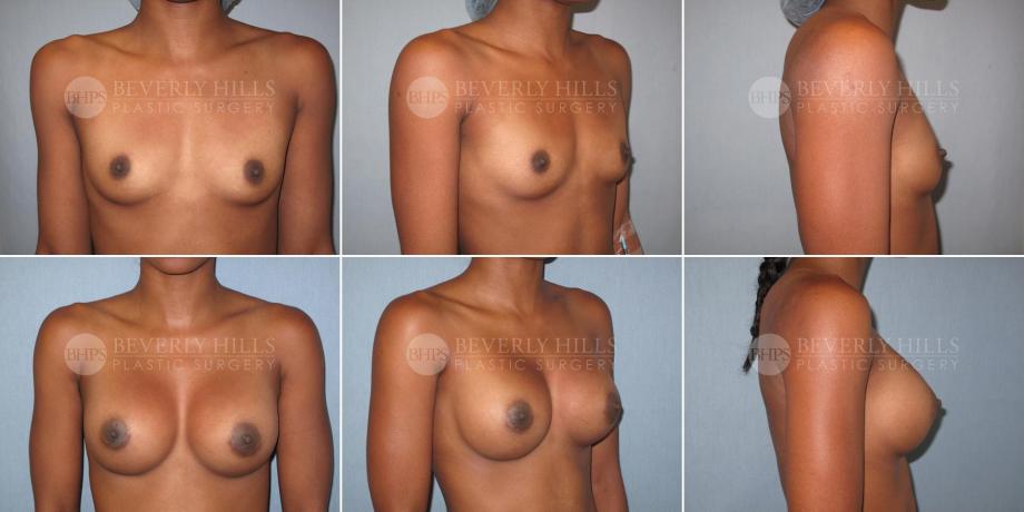 Beverly Hills Plastic Surgery gallery image 335