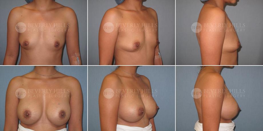 Beverly Hills Plastic Surgery gallery image 337