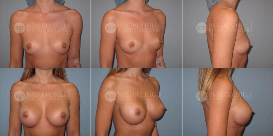 Beverly Hills Plastic Surgery gallery image 339