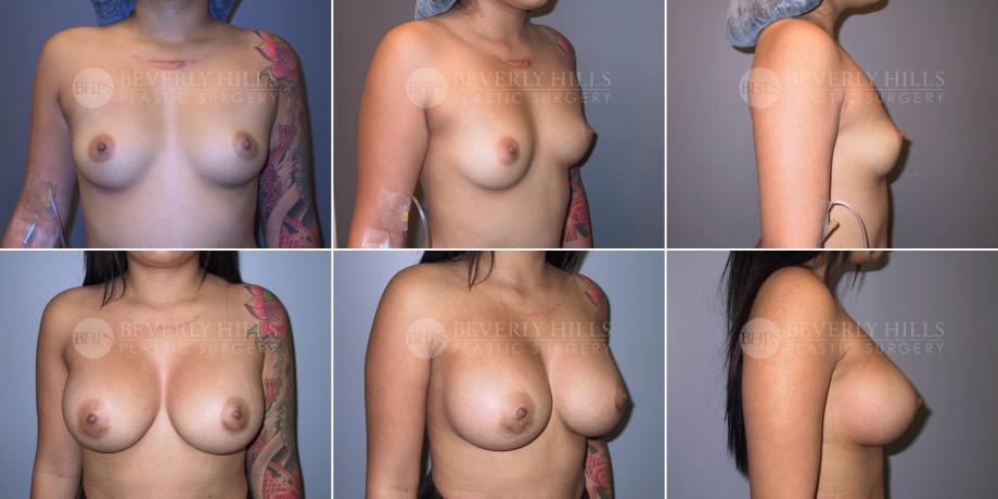 Beverly Hills Plastic Surgery gallery image 340