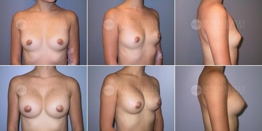 Beverly Hills Plastic Surgery gallery image 343