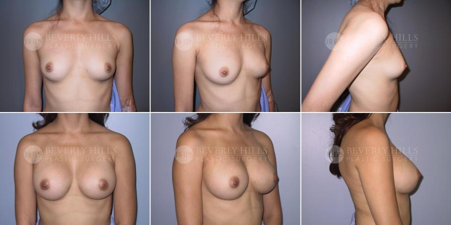 Beverly Hills Plastic Surgery gallery image 344