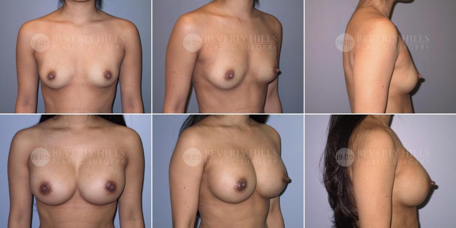 Beverly Hills Plastic Surgery gallery image 347