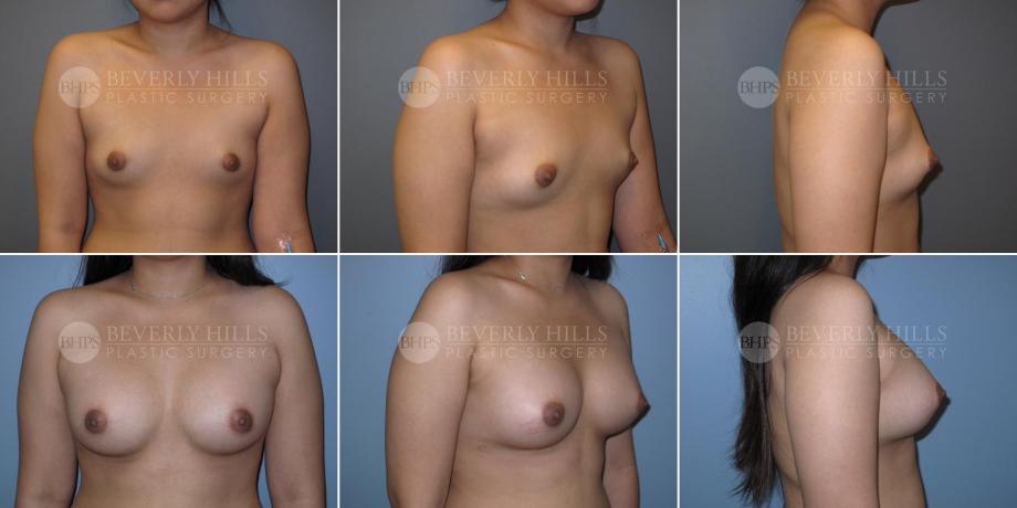 Beverly Hills Plastic Surgery gallery image 351