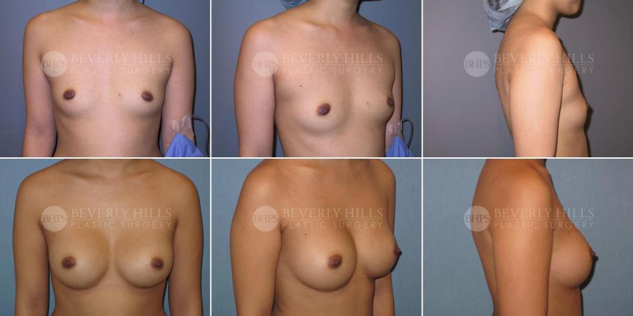 Beverly Hills Plastic Surgery gallery image 352