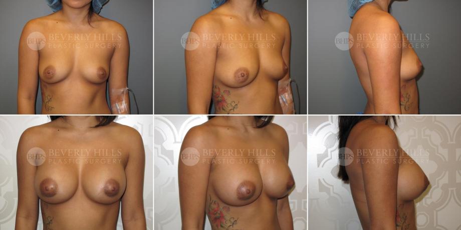 Beverly Hills Plastic Surgery gallery image 354