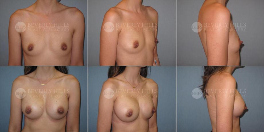 Beverly Hills Plastic Surgery gallery image 363