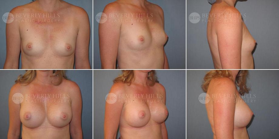 Beverly Hills Plastic Surgery gallery image 368