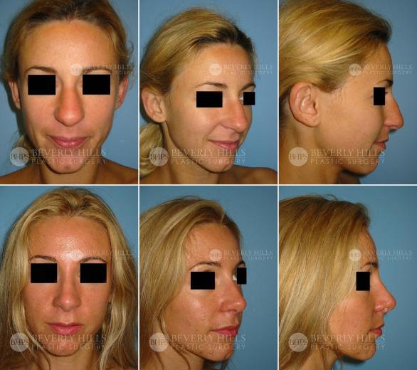 Beverly Hills Plastic Surgery gallery image 369