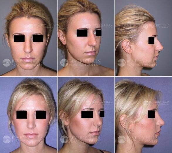 Beverly Hills Plastic Surgery gallery image 371
