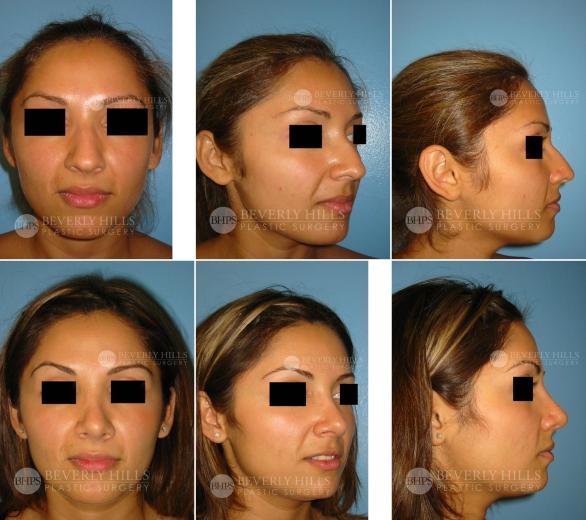 Beverly Hills Plastic Surgery gallery image 372