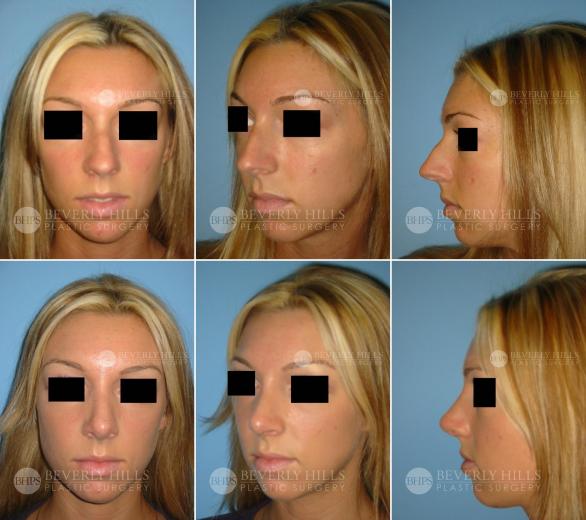 Beverly Hills Plastic Surgery gallery image 374